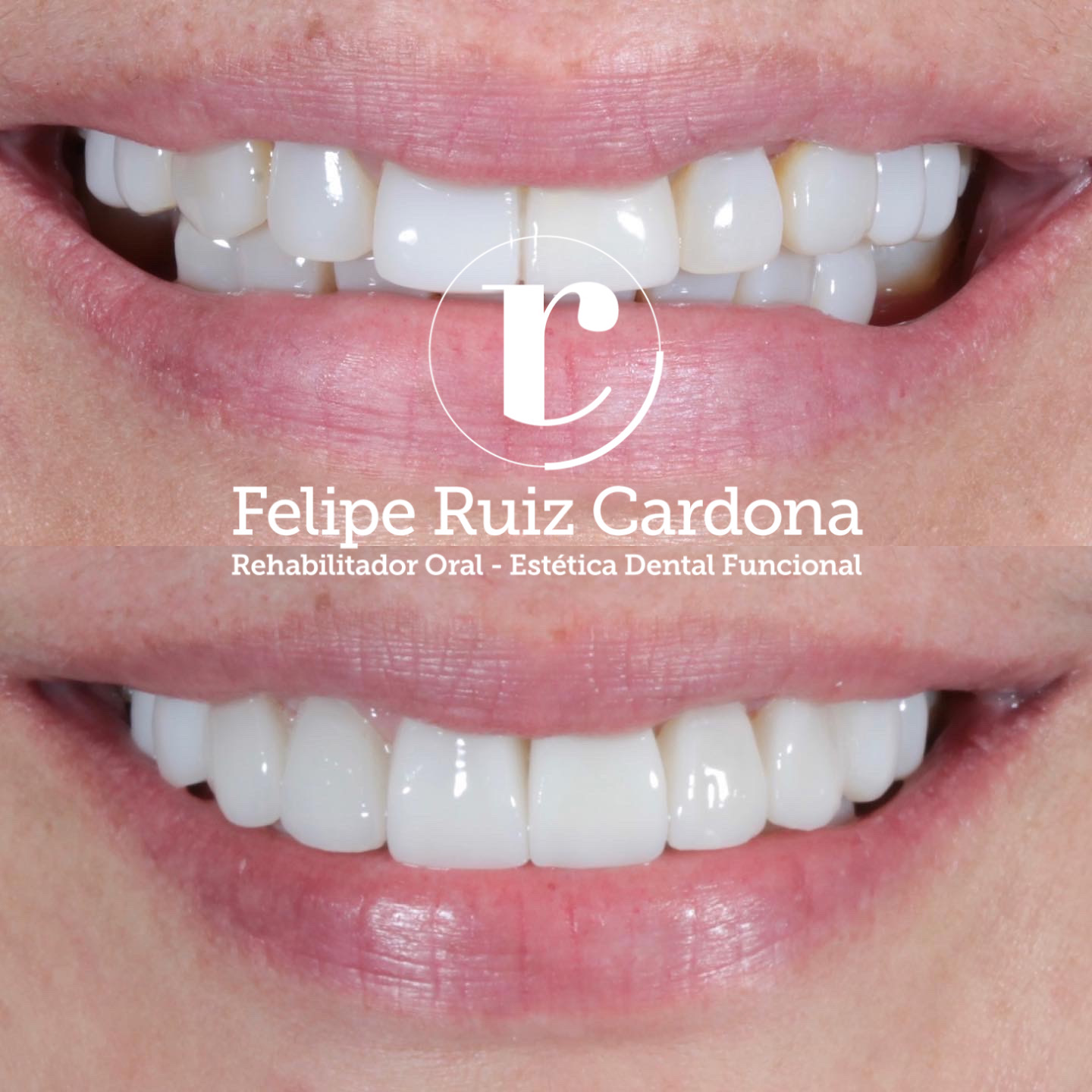 Porcelain Veneers 1